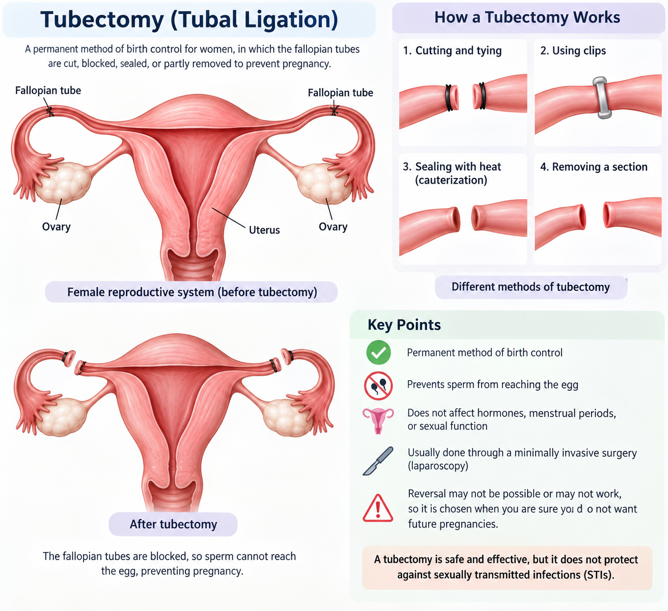 Illustration explaining tubectomy and female sterilisation