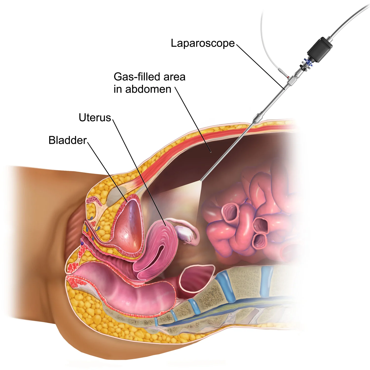 Gynaecological laparoscopy procedure and minimally invasive gynaecological surgery