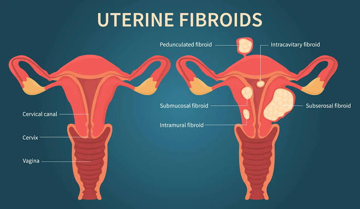 Uterine fibroids illustration
